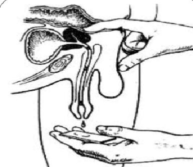 Massage prostate gland to obtain secretions