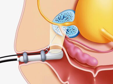 Punching the biopsy of the prostate gland