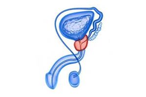 drawing of prostatitis